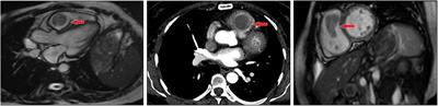 Case report: Cardiac metastatic leiomyoma in an Asian female